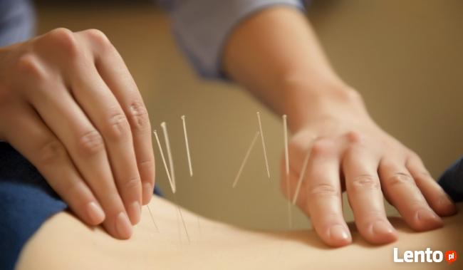 AKUPUNKTURA leczenie BÓLU, MIGREN, ZATOK, NAŁOGI, ODCHUDZANI