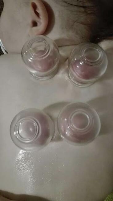 Stawianie baniek, Oczyszczanie zatok. Świecowanie uszu.