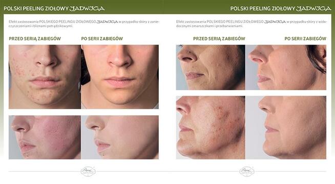 Promocja na zabiegi złuszczające w Endorfinie:)