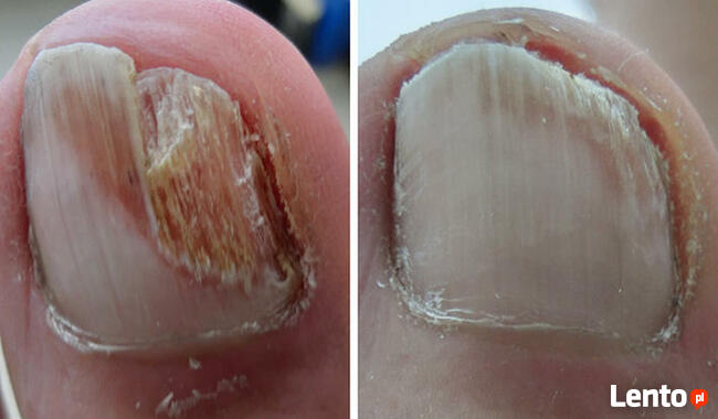 Podologia HELP PODOLOG Tarnowo Poznań