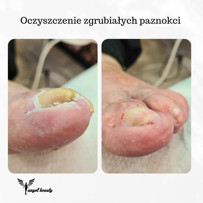 Pielęgnacja stóp SENIORA z dojazdem.