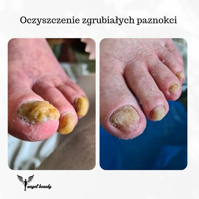 Pielęgnacja stóp SENIORA z dojazdem.