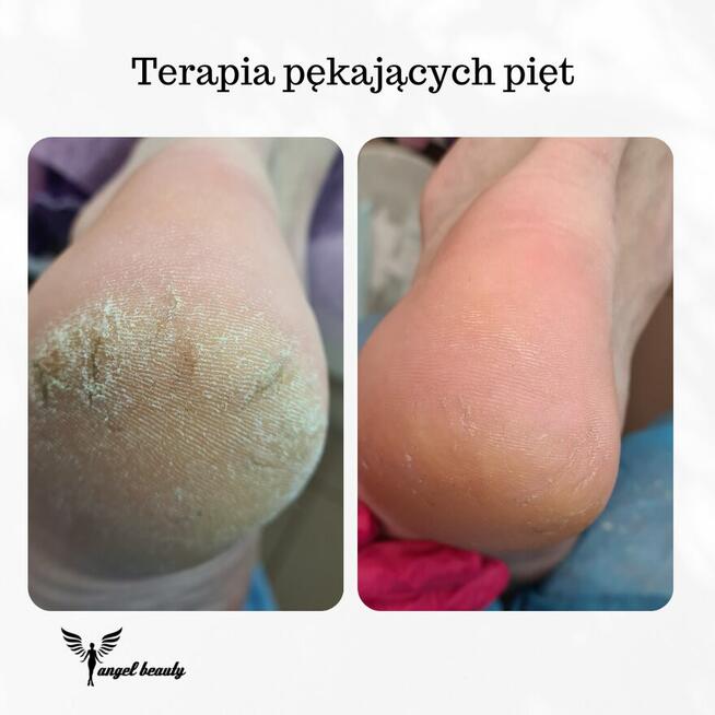 Pielęgnacja stóp SENIORA z dojazdem.