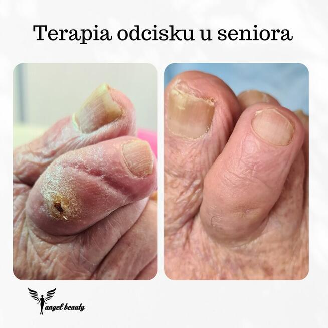Pielęgnacja stóp SENIORA z dojazdem.