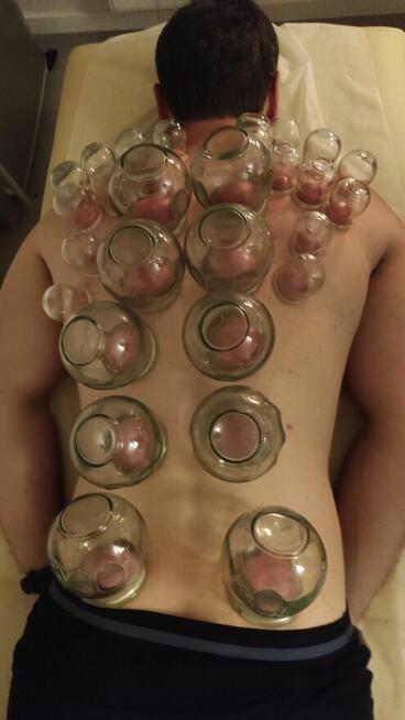 Stawianie baniek. Świecowanie uszu. Warszawa