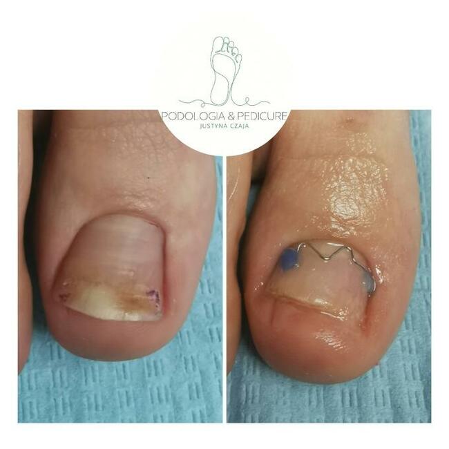 Podologia Justyna Czaja Gorzów Wielkopolski