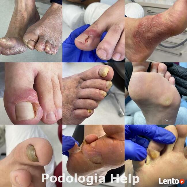 PODOLOGIA HELP TARNOWO Poznań Podolog