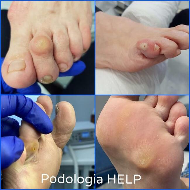 LASER - GRZYBICA - SKUTECZNIE POZNAŃ Tarnowo Podgórne