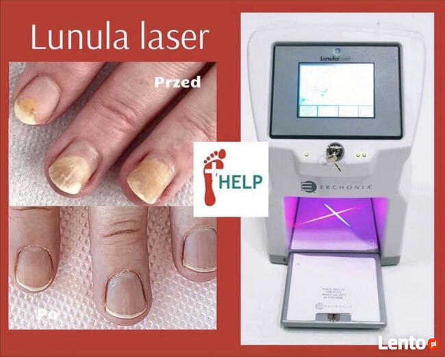 LASER - GRZYBICA - SKUTECZNIE POZNAŃ Tarnowo Podgórne