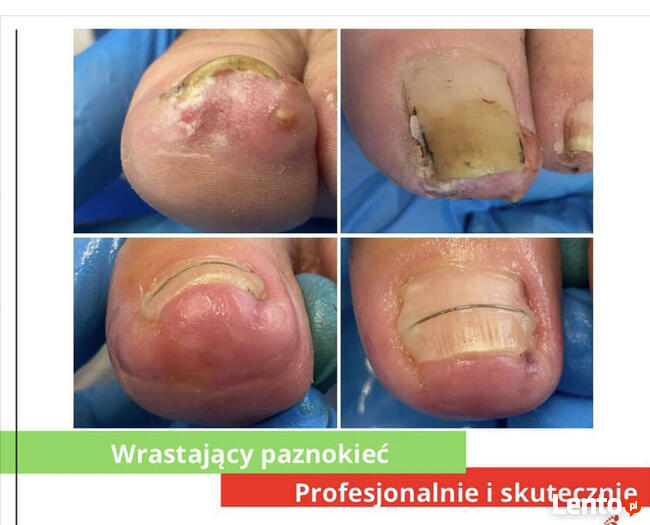 Podologia HELP PODOLOG Tarnowo Poznań