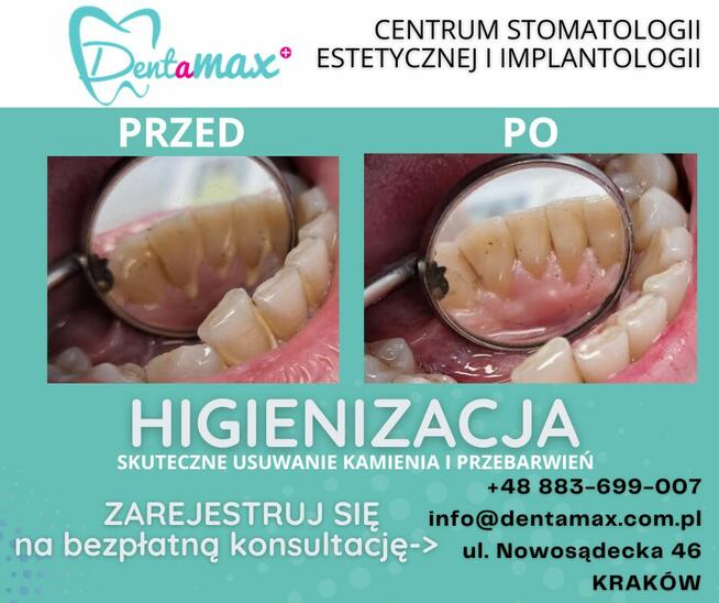 Higienizacja Zębów - Dentamax Kraków