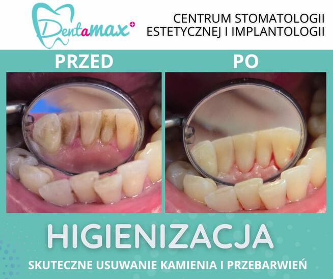 Higienizacja Zębów - Dentamax Kraków