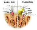 Paradontoza, mikrobiologiczny test na paradontozę, leczenie - 3