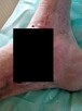 Pilna pomoc cegiełka 10 zł Udaje się uniknąć amputacji - 4