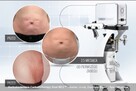Carboxytherapy karboksyterapia-odchudzanie,ujędrnienie skóry - 2