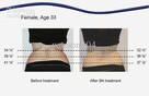 Fit&Roll! Kriolipoliza, Lipolaser, Ultradźwięki - 3w1 - 8