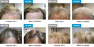 Laseroterapia NTL na porost włosów - urządzenie stymulujące - 2
