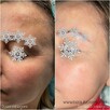 Bezbolesne Oczyszczanie twarzy + konsultacja kosmetologa - 5