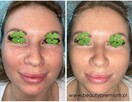 Bezbolesne Oczyszczanie twarzy + konsultacja kosmetologa - 2