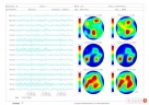 Badanie EEG , QEEG - Mapa Mózgu BEAM , NEUROLOG DZIECIĘCY ! - 2
