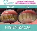 Higienizacja Zębów - Dentamax Kraków