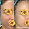 Bezbolesne Oczyszczanie twarzy + konsultacja kosmetologa - 1