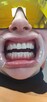 wybielanie zębów lampą, Stomatologia, stomatolog, dentysta, - 3