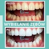 Skuteczne wybielanie zębów Kraków - Dentamax Nowosądecka 46 - 3