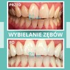 Skuteczne wybielanie zębów Kraków - Dentamax Nowosądecka 46 - 4