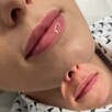 Modelowanie powiększanie ust Usuwanie zmarszczek Botox - 9