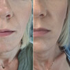 Modelowanie powiększanie ust Usuwanie zmarszczek Botox - 12