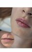 Modelowanie powiększanie ust Usuwanie zmarszczek Botox - 3