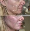Modelowanie powiększanie ust Usuwanie zmarszczek Botox - 5