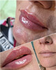 Modelowanie powiększanie ust Usuwanie zmarszczek Botox - 11