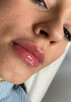 Modelowanie powiększanie ust Usuwanie zmarszczek Botox - 13
