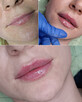 Modelowanie powiększanie ust Usuwanie zmarszczek Botox - 10