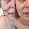 Modelowanie powiększanie ust Usuwanie zmarszczek Botox - 8