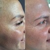 Modelowanie powiększanie ust Usuwanie zmarszczek Botox - 6