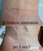 Laserowe usuwanie tatuaży,przebarwień,piegów,znamion,itp - 2