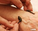 Leczenie Pijawkami Lekarskimi Bytom - 3