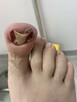 Chemioterapia- wrastające i wkręcające się paznokcie - 3
